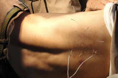 How Does Dry Needling Work1
