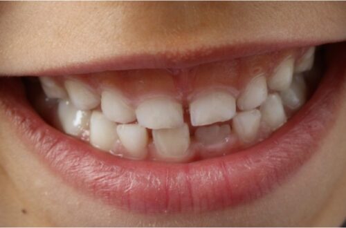 14. How Long Do Fillings Take for Tooth Cavities1