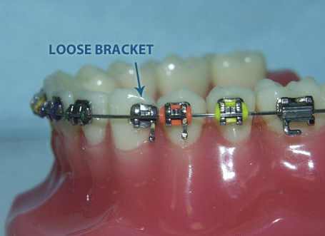 Loose Bracket1