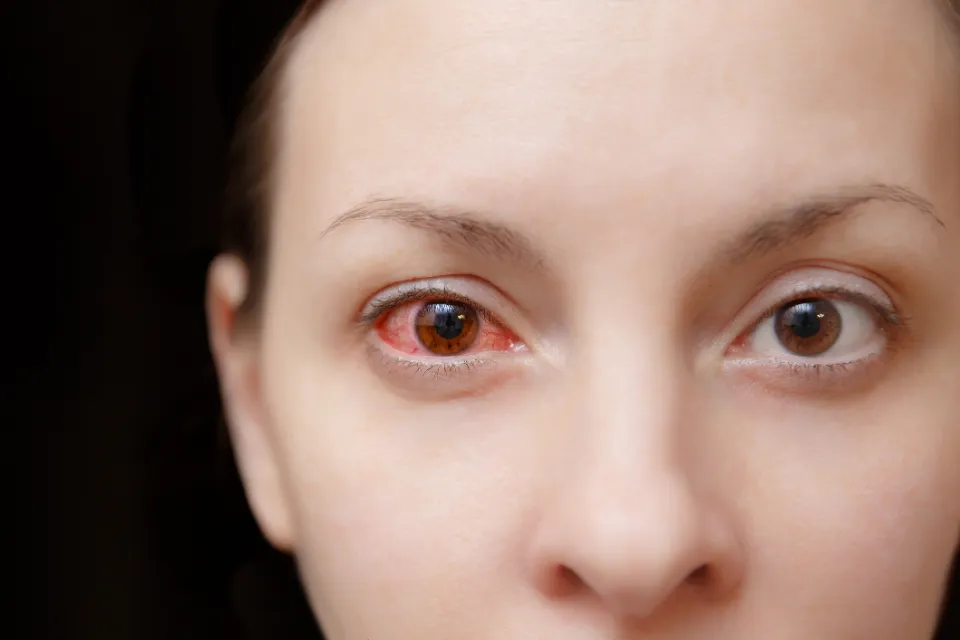 Can You Get Pink Eye From Poop - What You Should Pay Attention