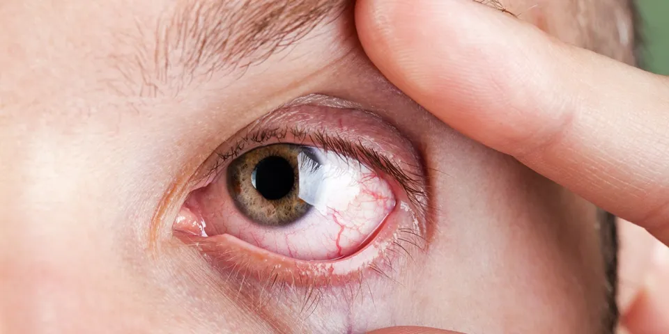 Can You Get Pink Eye From Poop - What You Should Pay Attention