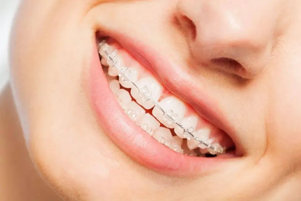 How Do Braces Work - Will  Braces Straighten Teeth?