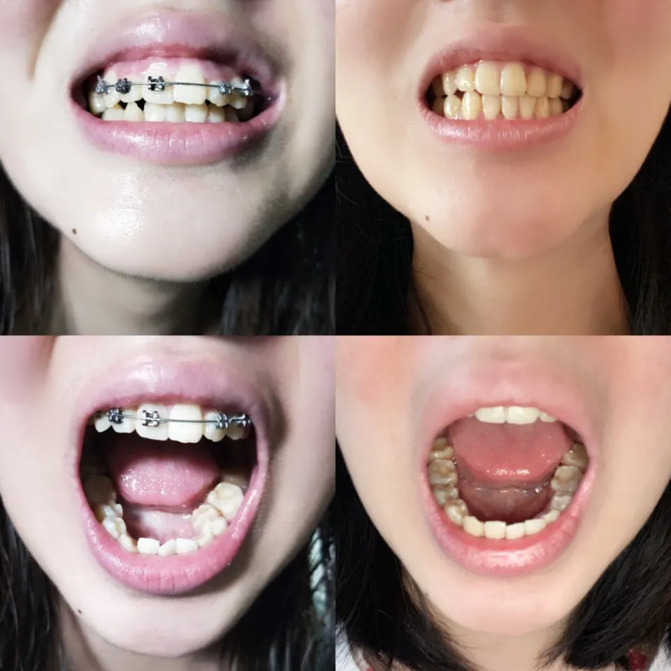 How Do Braces Work - Will  Braces Straighten Teeth?