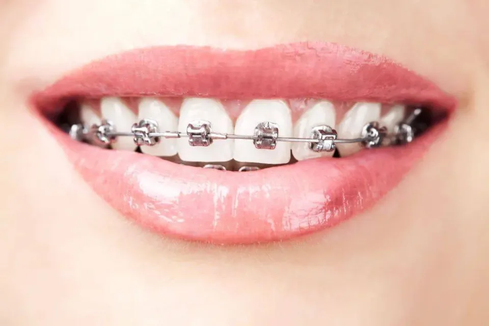 How Do Braces Work - Will  Braces Straighten Teeth?