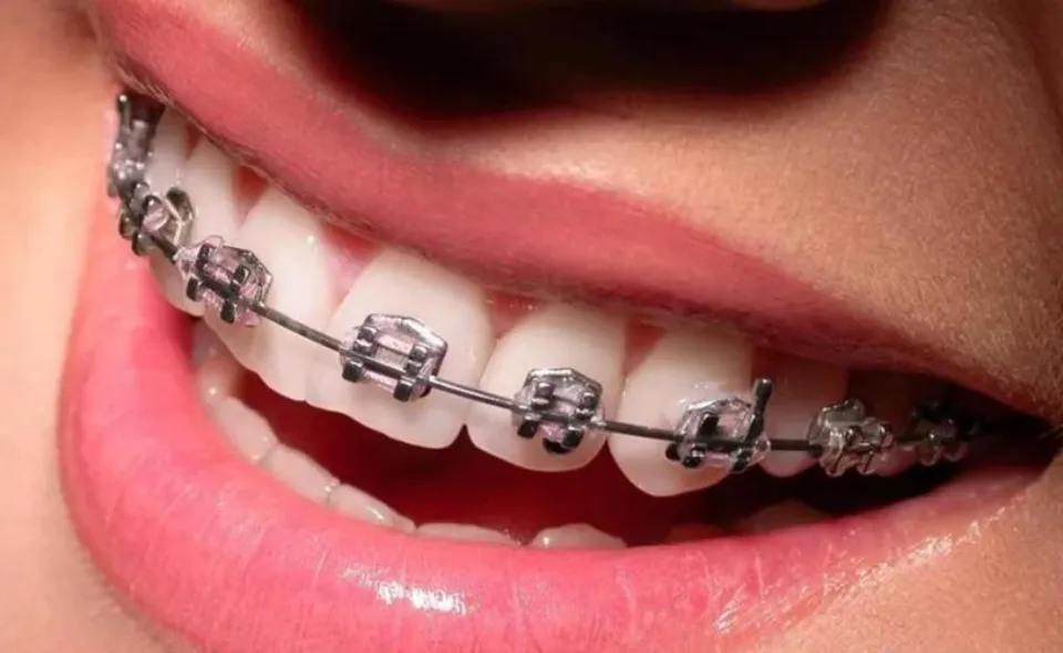 How Do Braces Work - Will  Braces Straighten Teeth?