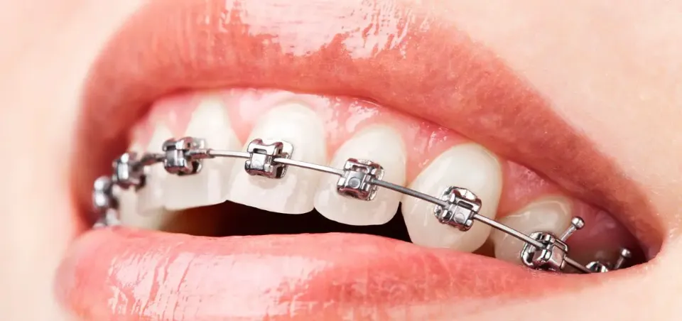 How Do Braces Work - Will  Braces Straighten Teeth?