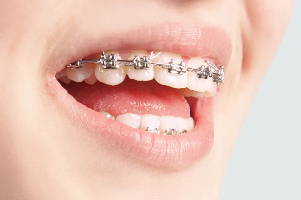 How Do Braces Work - Will  Braces Straighten Teeth?