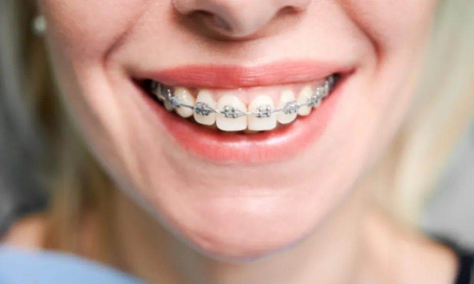 How Do Braces Work - Will  Braces Straighten Teeth?