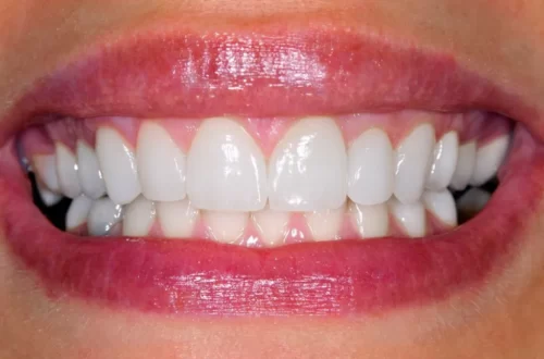 Can Braces Cause Gum Recession - What You Should Know