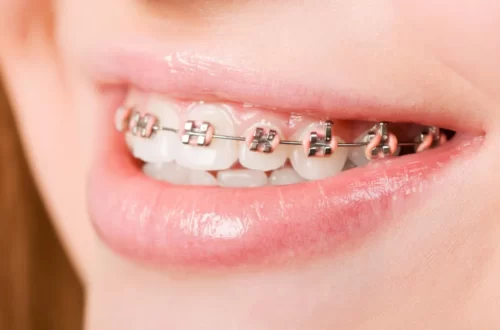How To Use Wax For Braces - How Long Should You Leave Wax
