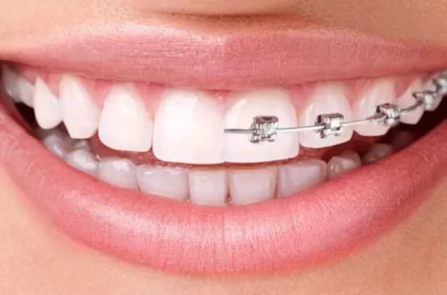 Invisalign vs. Traditional Braces - Which One Is Cheaper?