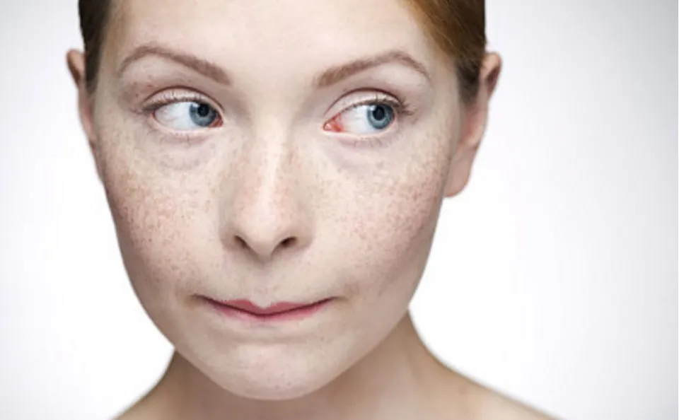Sun Spots vs. Freckles - Difference & How to Treat