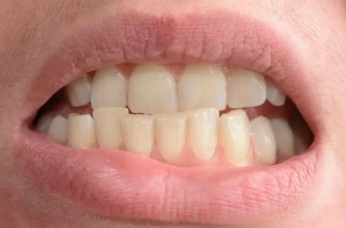 Why Do My Teeth Shift After Braces - How to Fix It?