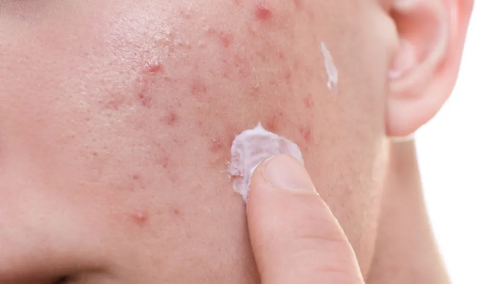 Acne Marks vs Acne Scars - Characteristics & Treatments