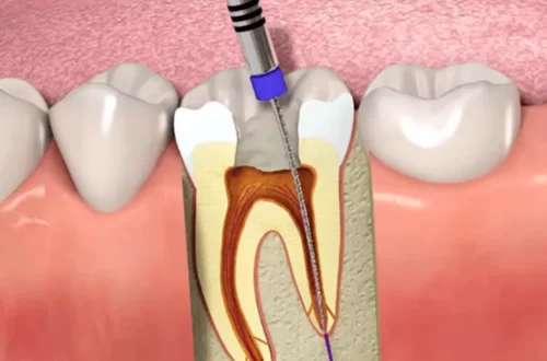 Are Root Canal Safe - Debunking Common Myths