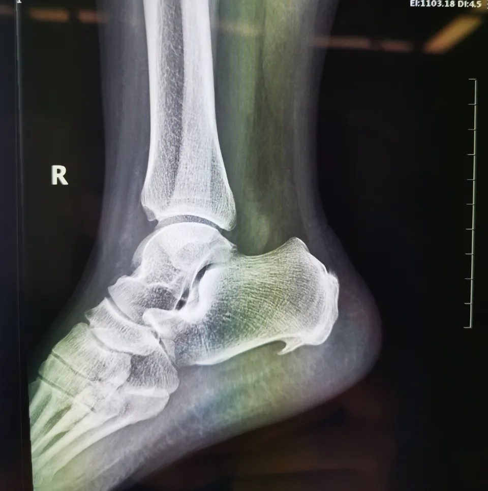 Bunion Vs. Bone Spur Differences and Treatment Options The Smart