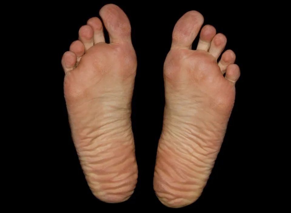 Bunion Vs. Bone Spur Differences and Treatment Options The Smart