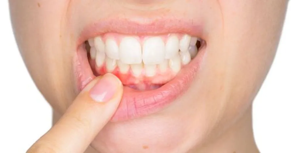 Can Gum Disease Kill You - the Looming Threat