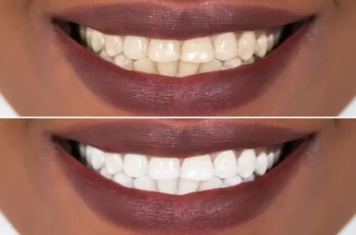 Herbaluxy Teeth Whitening Reviews - Unveiling the Secrets of a Radiant Smile