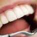 How Long Can Cavities Untreated - Everything You Should Know