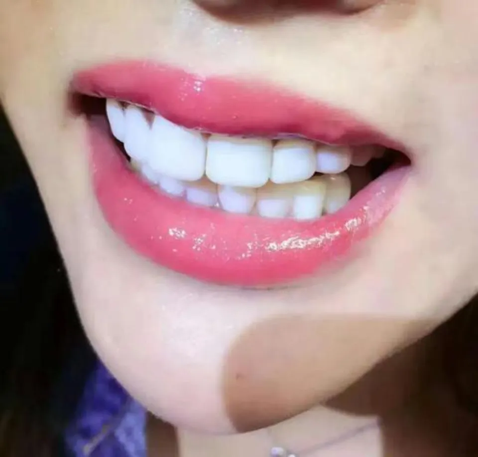 How Often Should I Use Whitening Strips - Brightening Your Smile