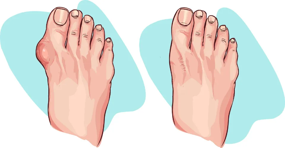 Is Bunion Surgery Covered by Insurance - What You Need to Know