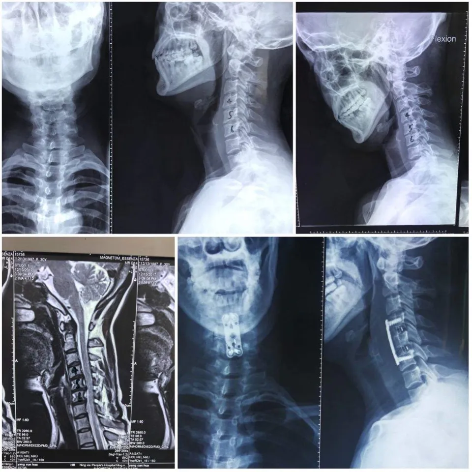 Permanent Restrictions After ACDF Surgery - Navigate Them Effectively